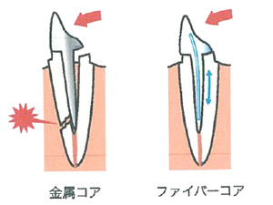 金属コア