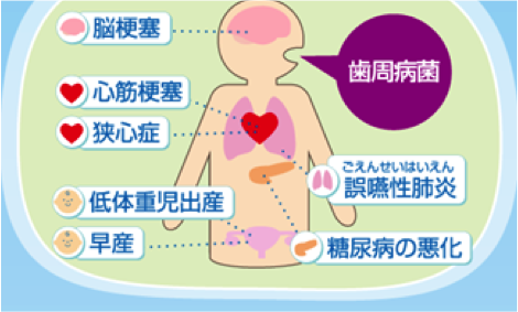 全身と歯周病