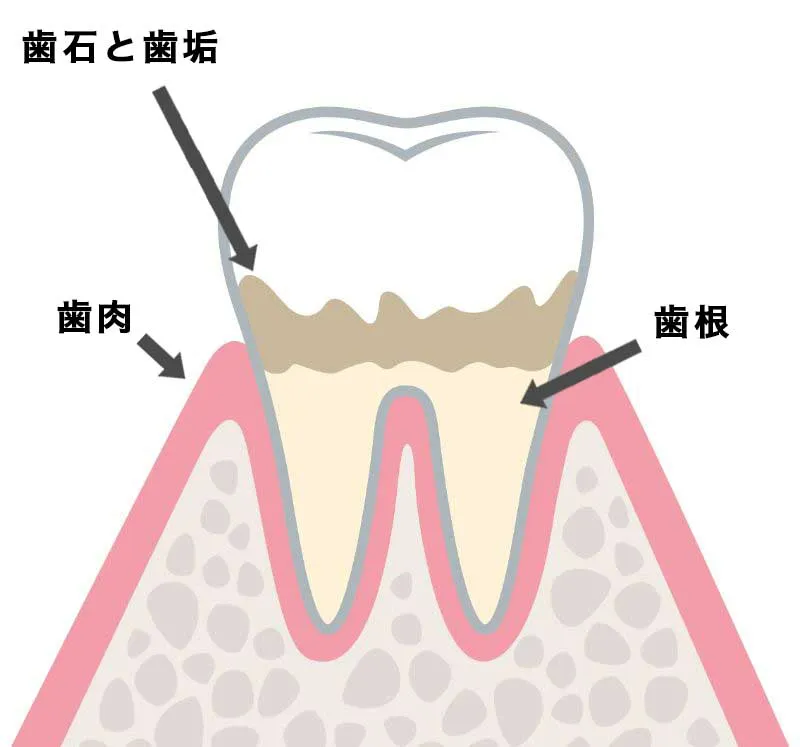 C0(初期虫歯)