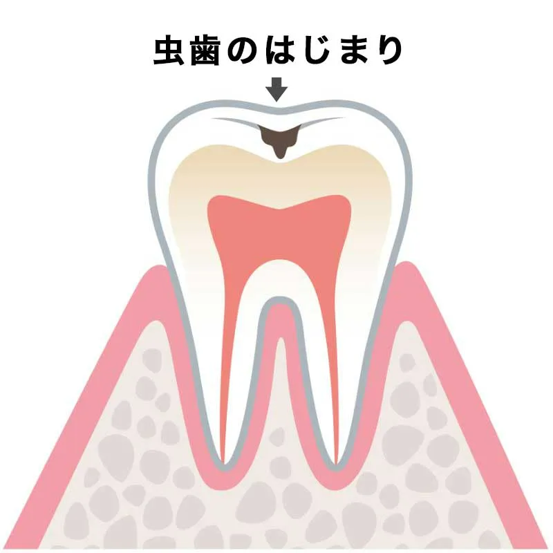 C0(初期虫歯)