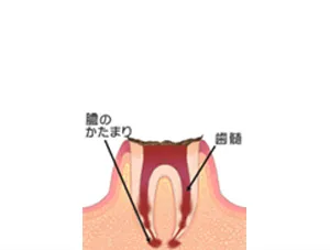 C4(歯根に虫歯が達する)