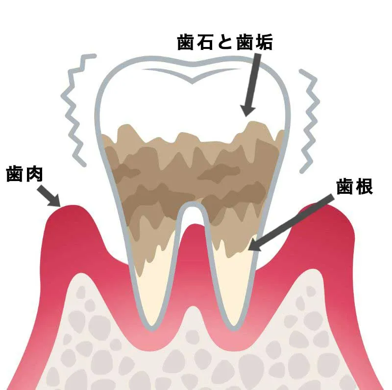 進行段階:P4(重度歯周炎)