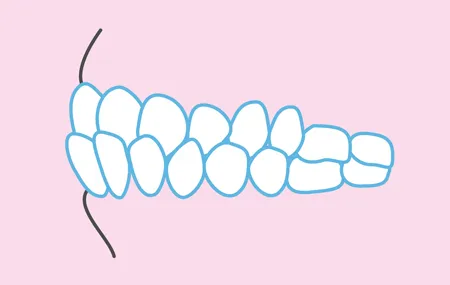 下の歯列が上の歯列よりも前に出ている、受け口で悩んでいる