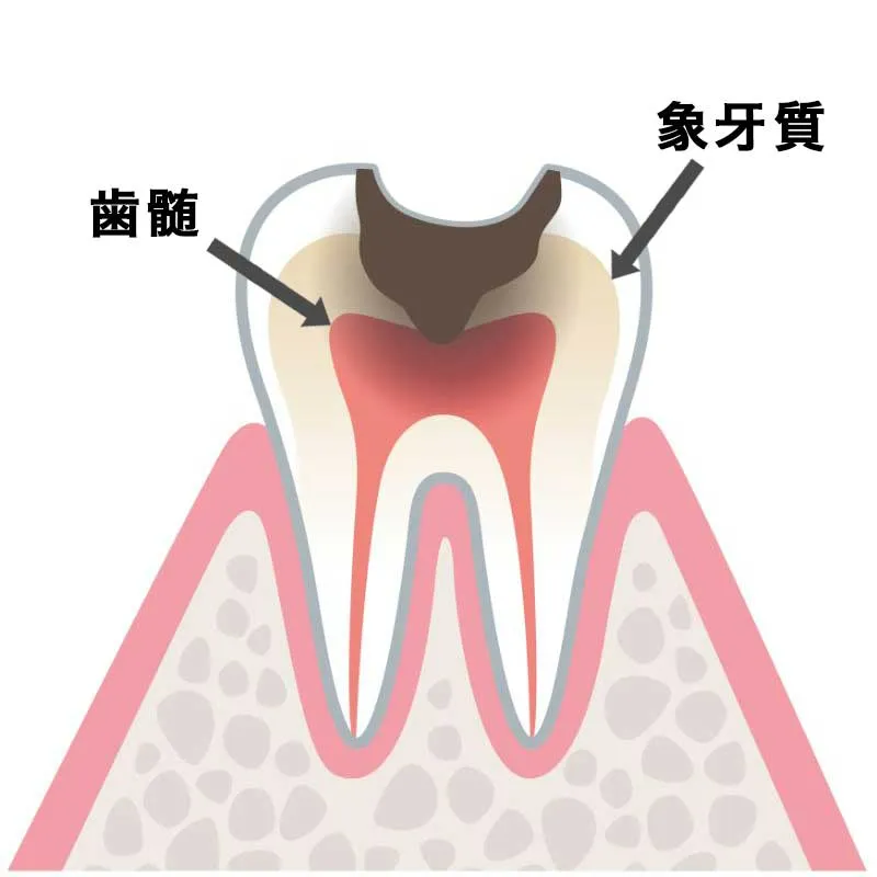 C2(象牙質が虫歯)