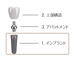 インプラント（人口歯根）