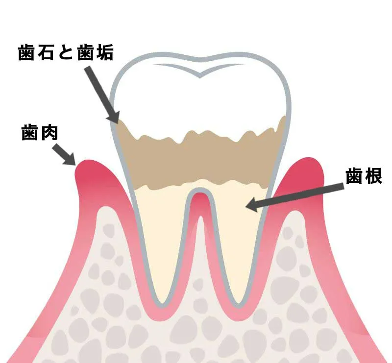 進行段階:P2(軽度歯周炎)
