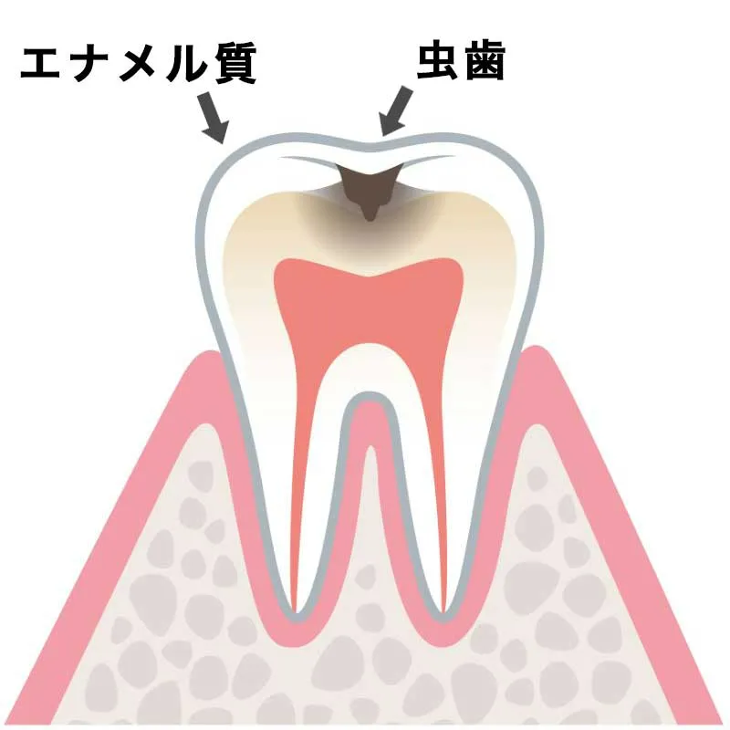 C1(エナメル質が虫歯)