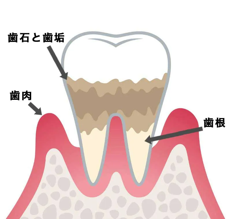 進行段階:P3(中度歯周炎)