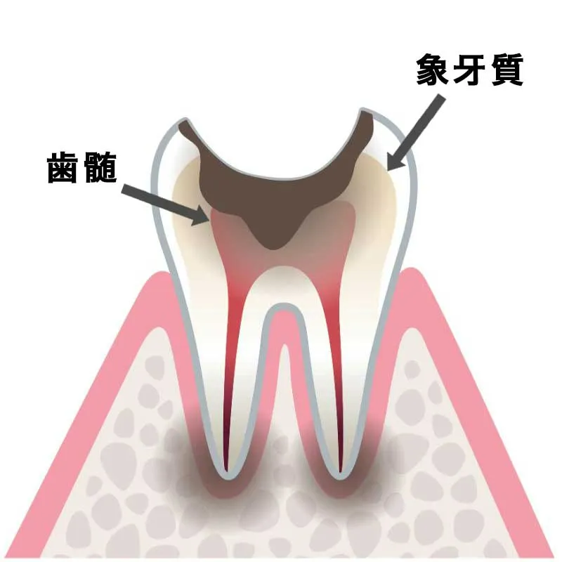 C3(虫歯が神経に達する)
