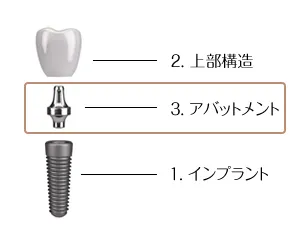 アバットメント