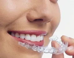 インビザラインマウスピース矯正